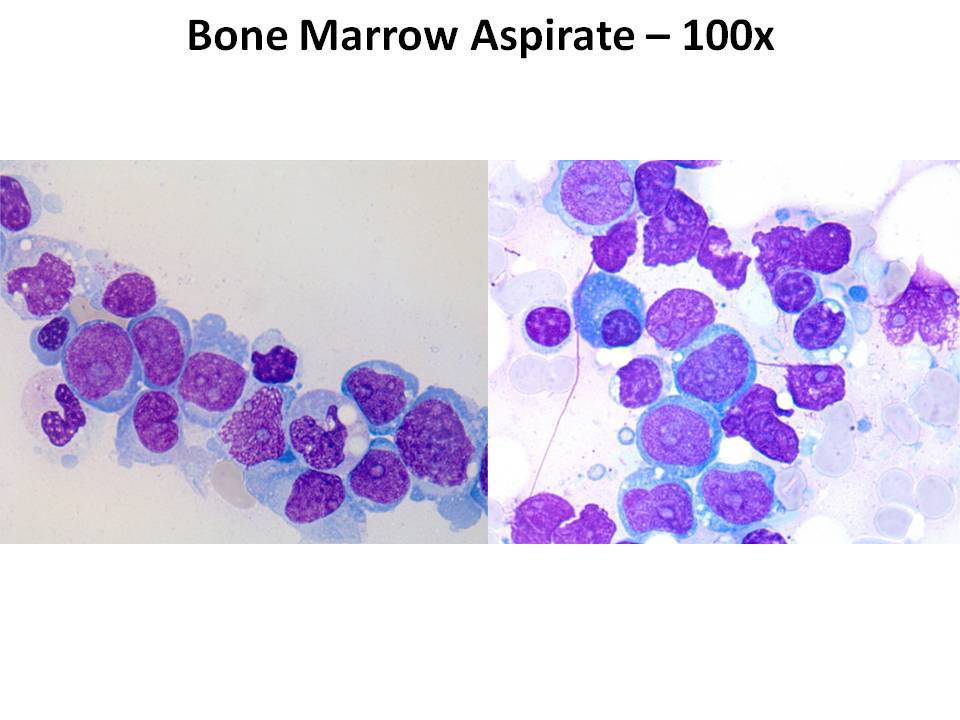 Bone marrow aspirate - 100x